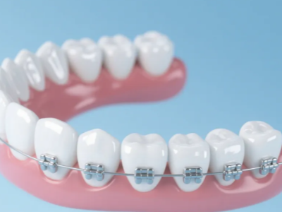 想做牙齒矯正，哪種方案更適合你？