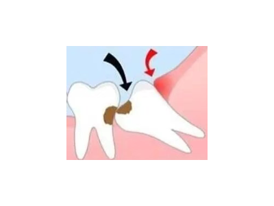 吃完飯后老塞牙？別大意！這可能是你的牙齒在報警