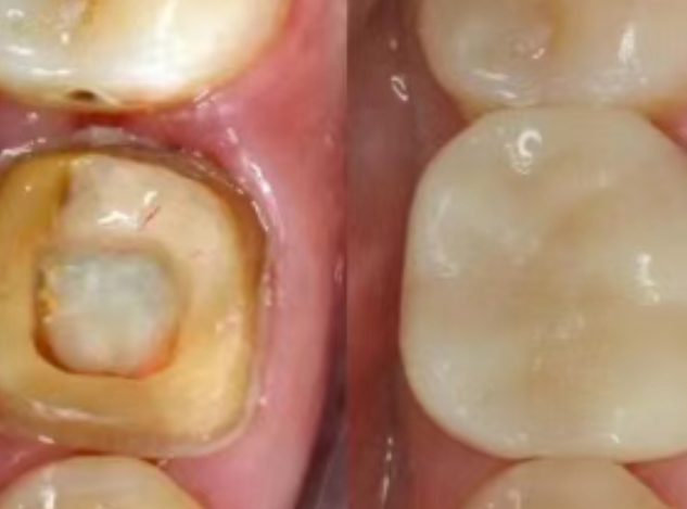 根管治療（抽神經(jīng)）后，為什么一定要做牙冠？