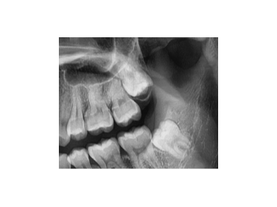 既然「智齒」不宜久留，為什么不能一次性拔掉？
