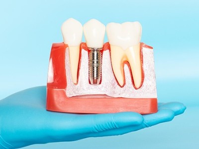種牙VS鑲牙，你適合哪種?