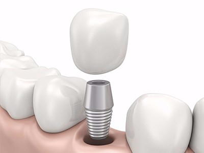 在承德哪家口腔醫(yī)院口腔種植齒好一點(diǎn)，惟德口腔醫(yī)院值得您的選擇