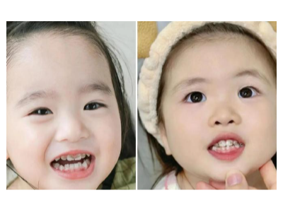 河北惟德口腔涂氟太貼心，孩子不抗拒，家長更省心